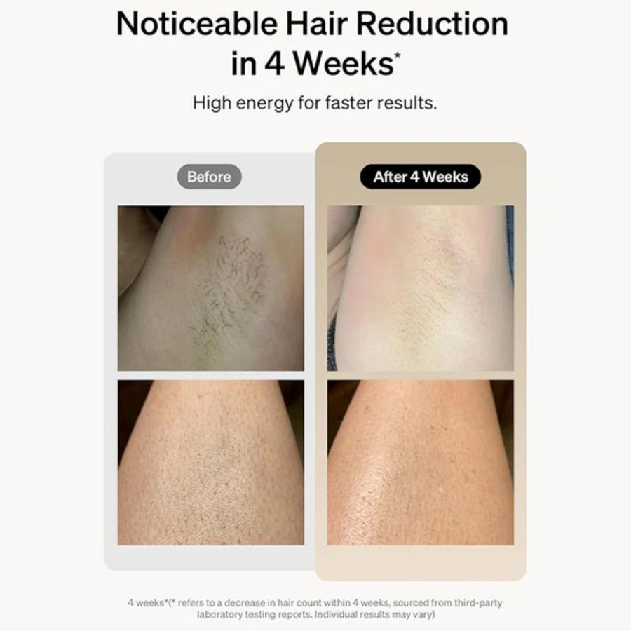 Professioneller Laser-Epilierer IPL-Haarentfernung Körper Bikini Bein Haarentfernungsgerät 900.000 Blitze 5 Stufen Epilierer Schmerzfreie elektrische Epiliermaschine